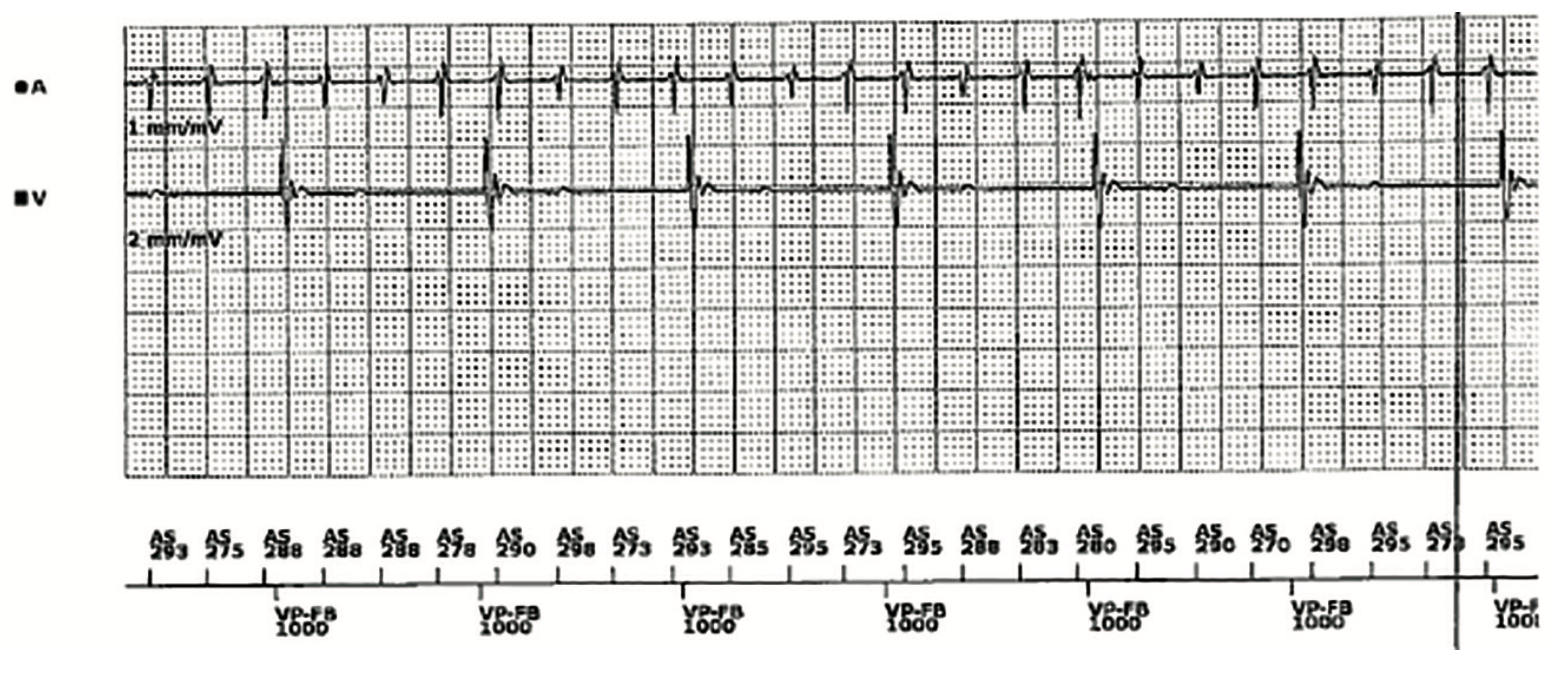 Smith Tachycardia Figure 2