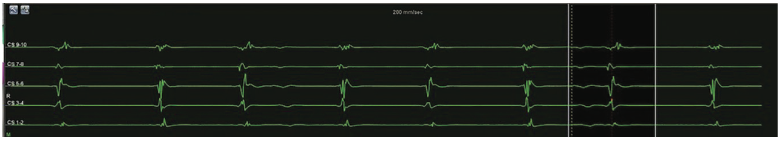 Smith Tachycardia Figure 3