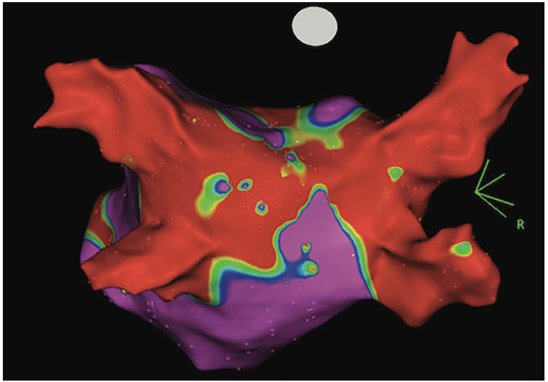 Smith Tachycardia Figure 4