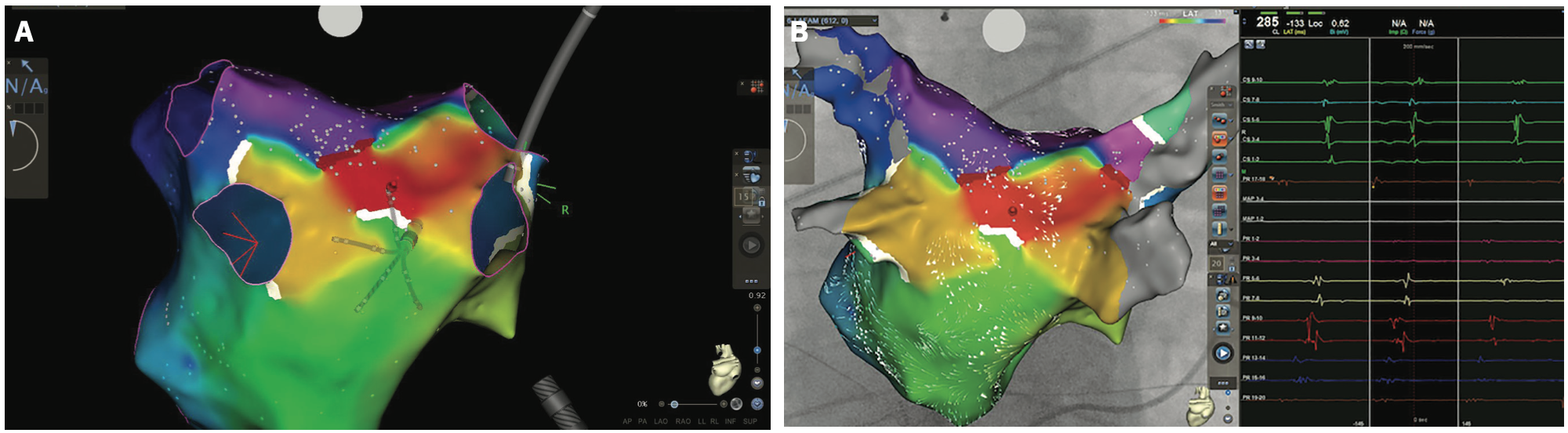 Smith Tachycardia Figure 5