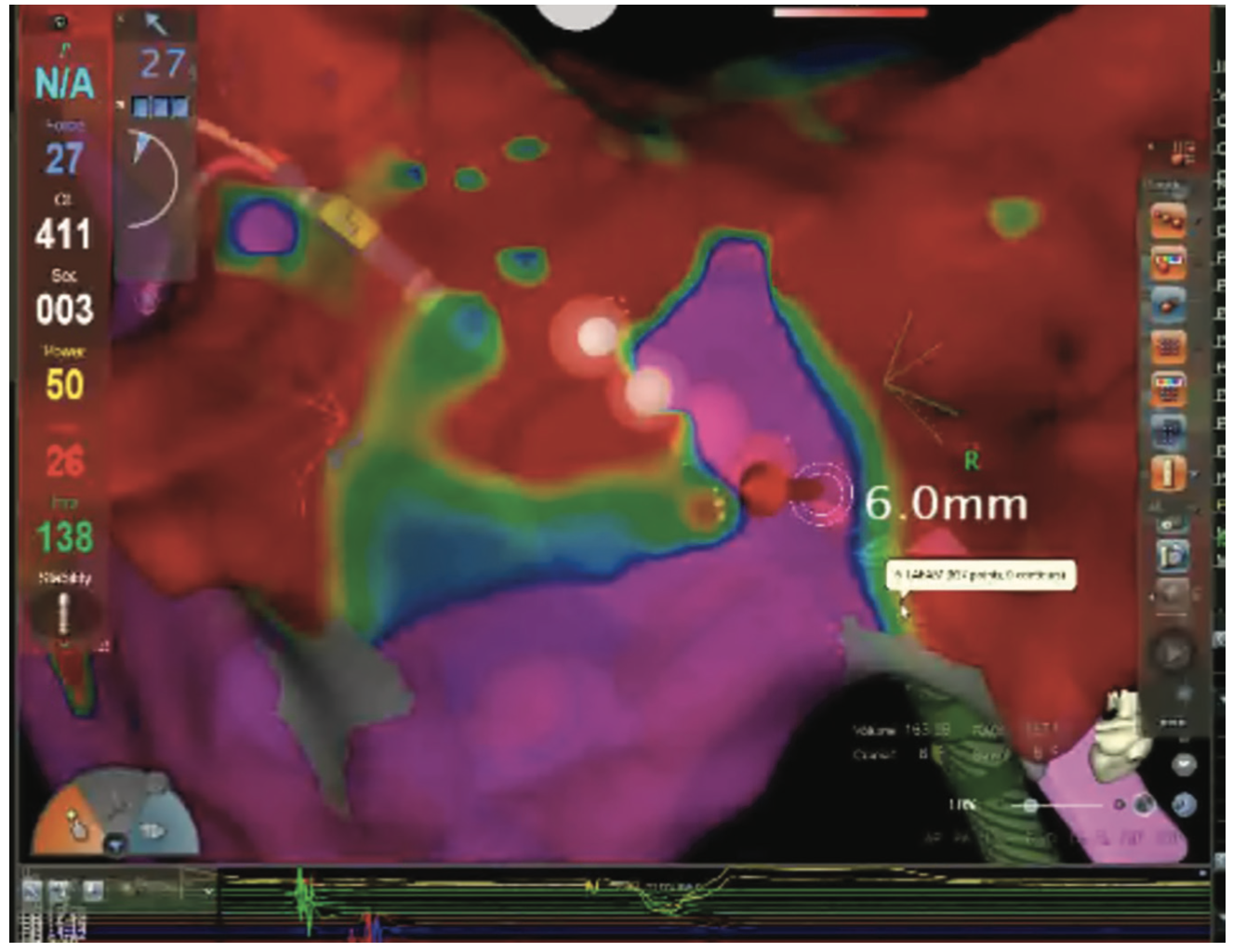 Smith Tachycardia Figure 7