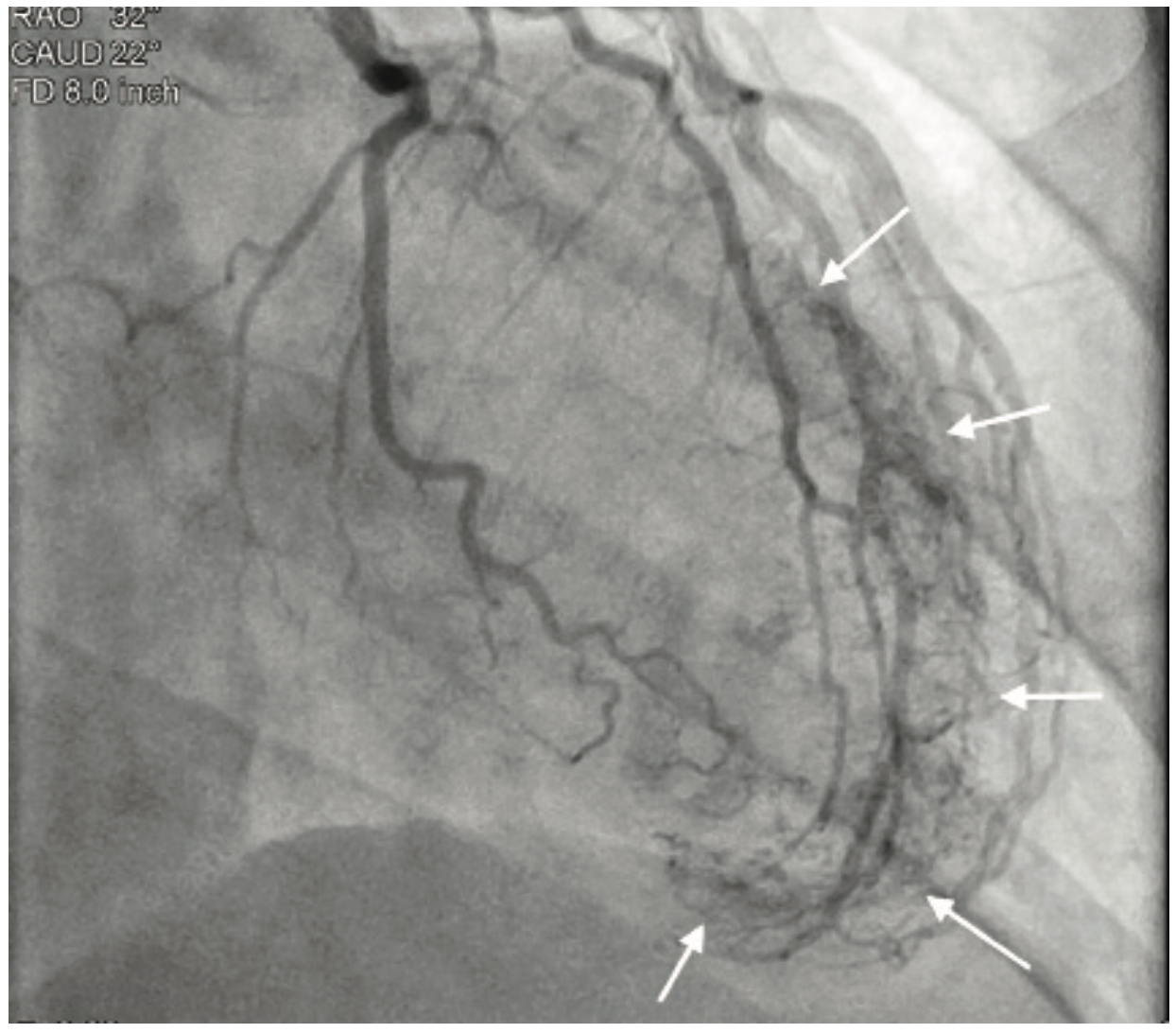 Smith Thebesian Veins Figure 1