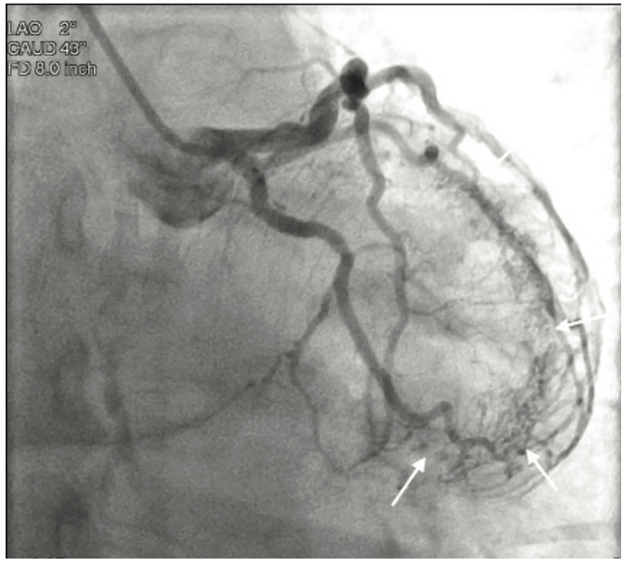 Smith Thebesian Veins Figure 2