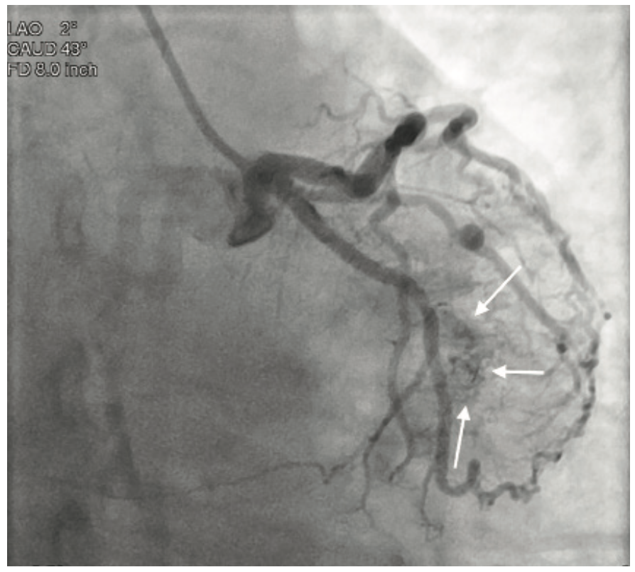 Smith Thebesian Veins Figure 3