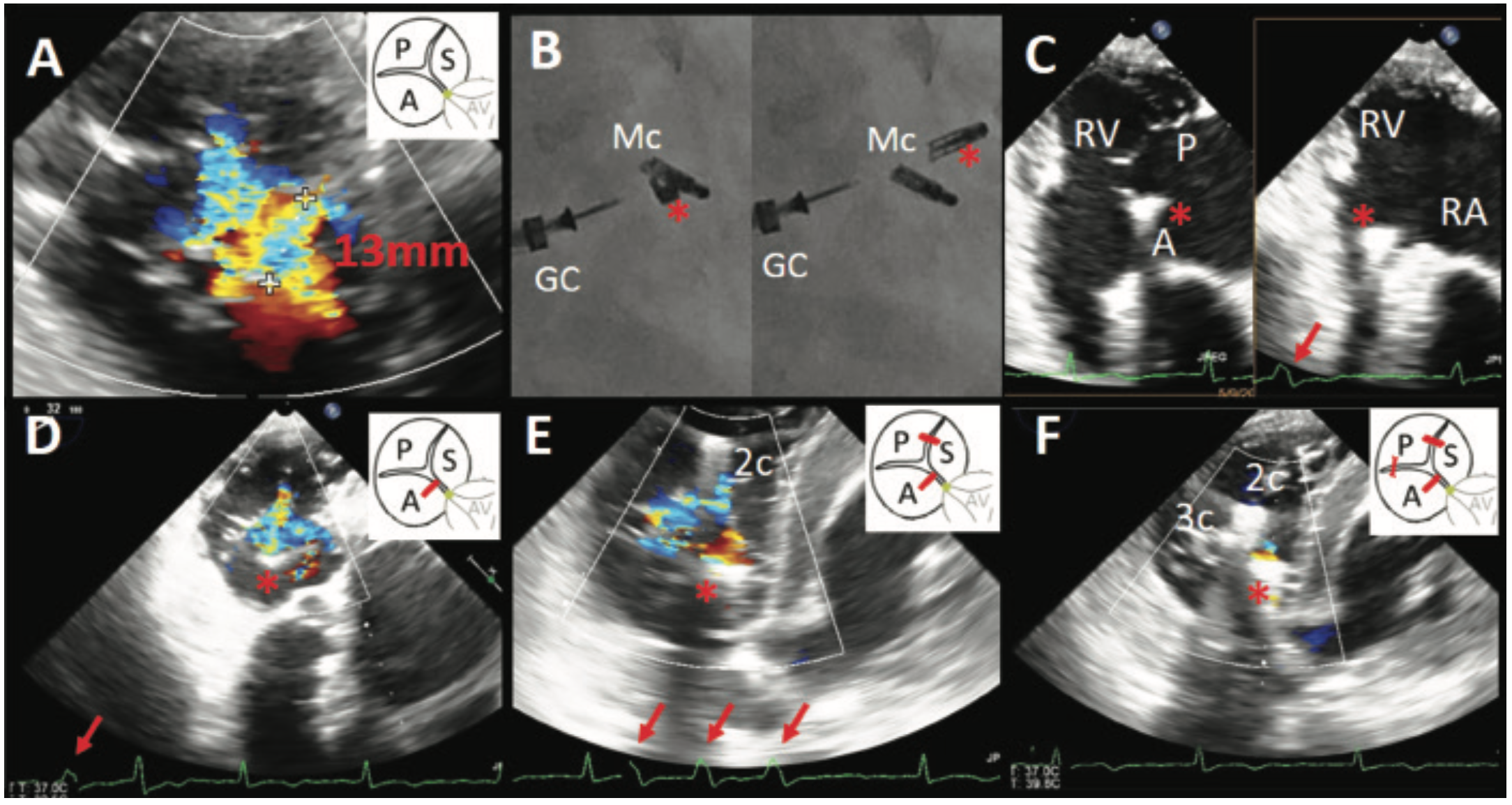 So MitraClip Figure 1