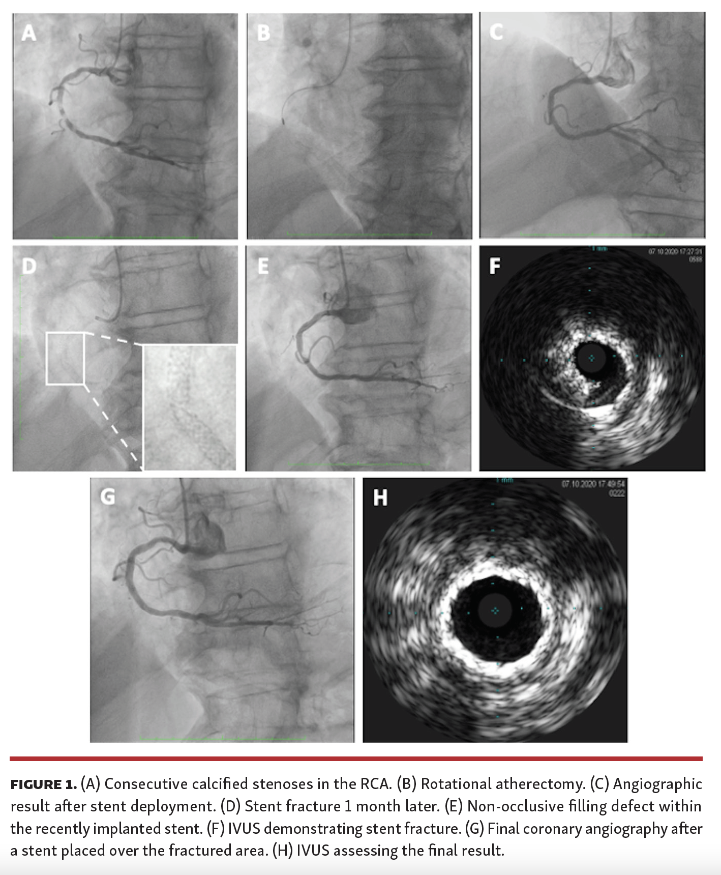Soulaidopoulos UA Induced by DES Fracture Fig 1