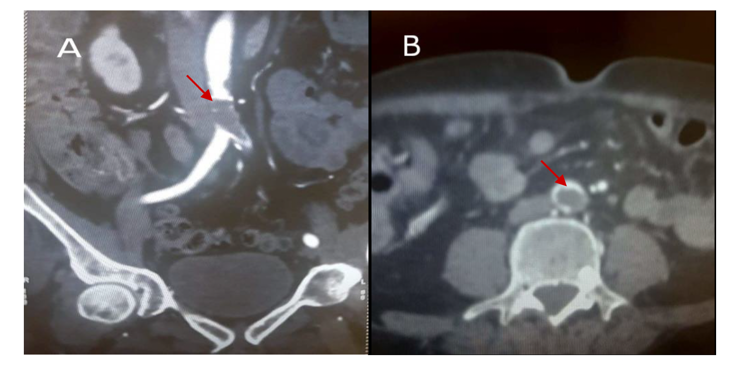 Figure 1. CT angiography image of floating mass obstructing practically the distal abdominal aorta and the origin of the left common iliac in an axial view (A) and sagittal view (B).