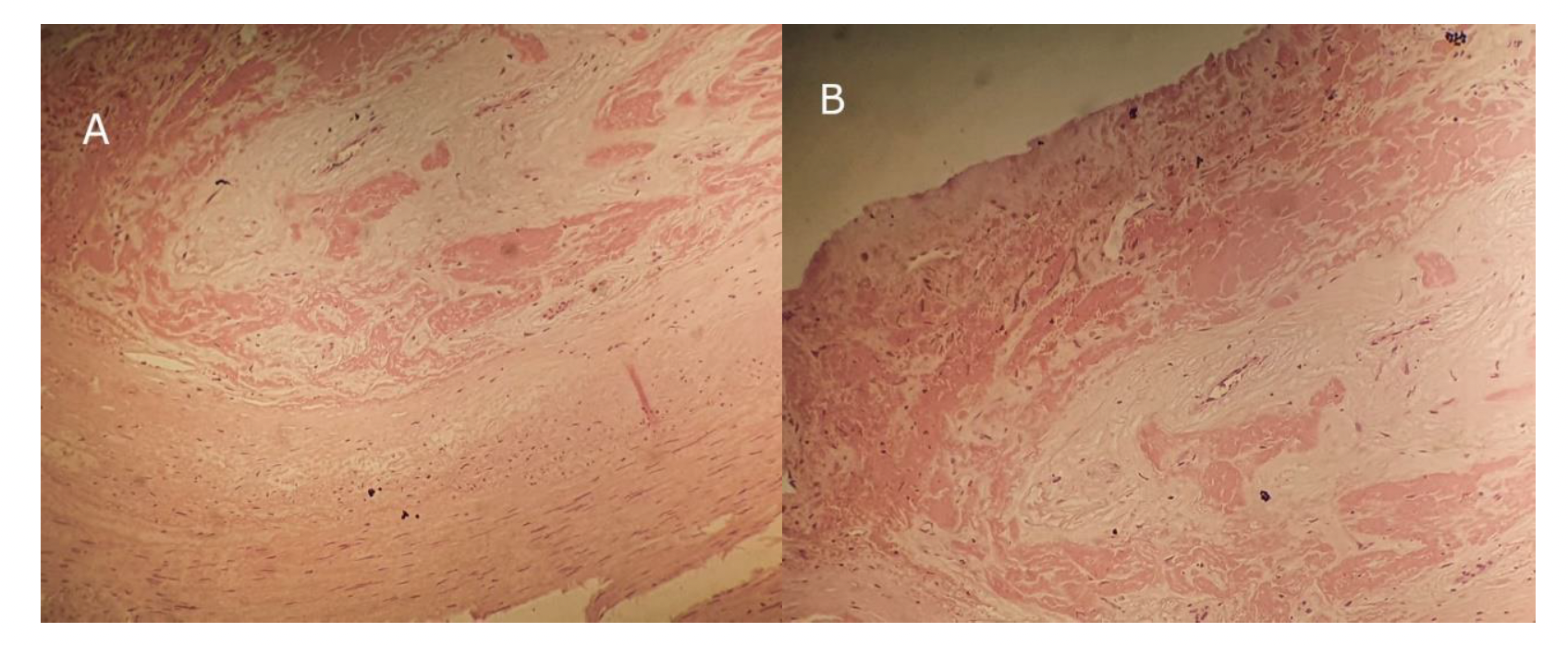 Figure 2. Pathological examination showing a widely ulcerated endothelial lining (A) with formation of an obliterating thrombosis (B).
