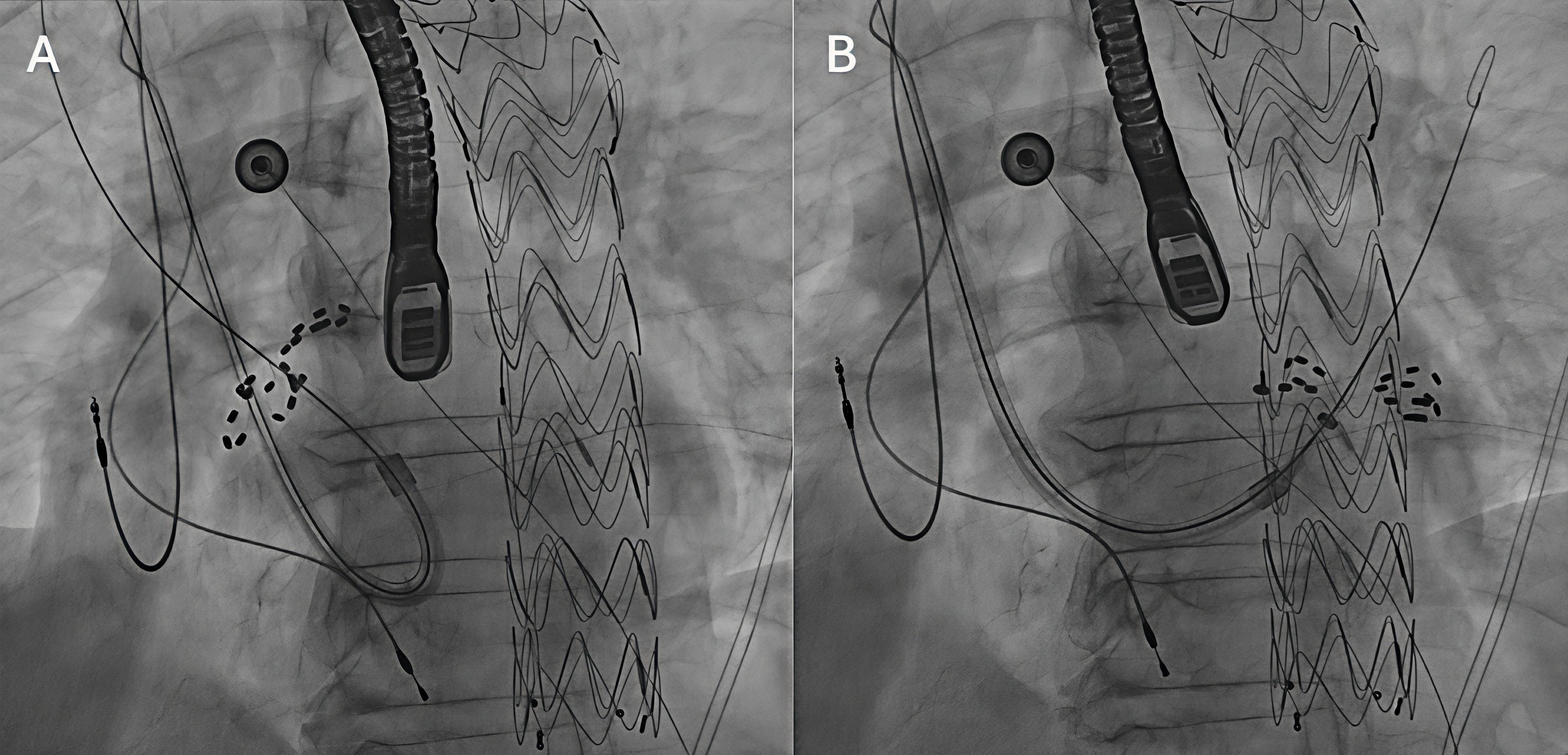 Figure 2. Catheter ablation