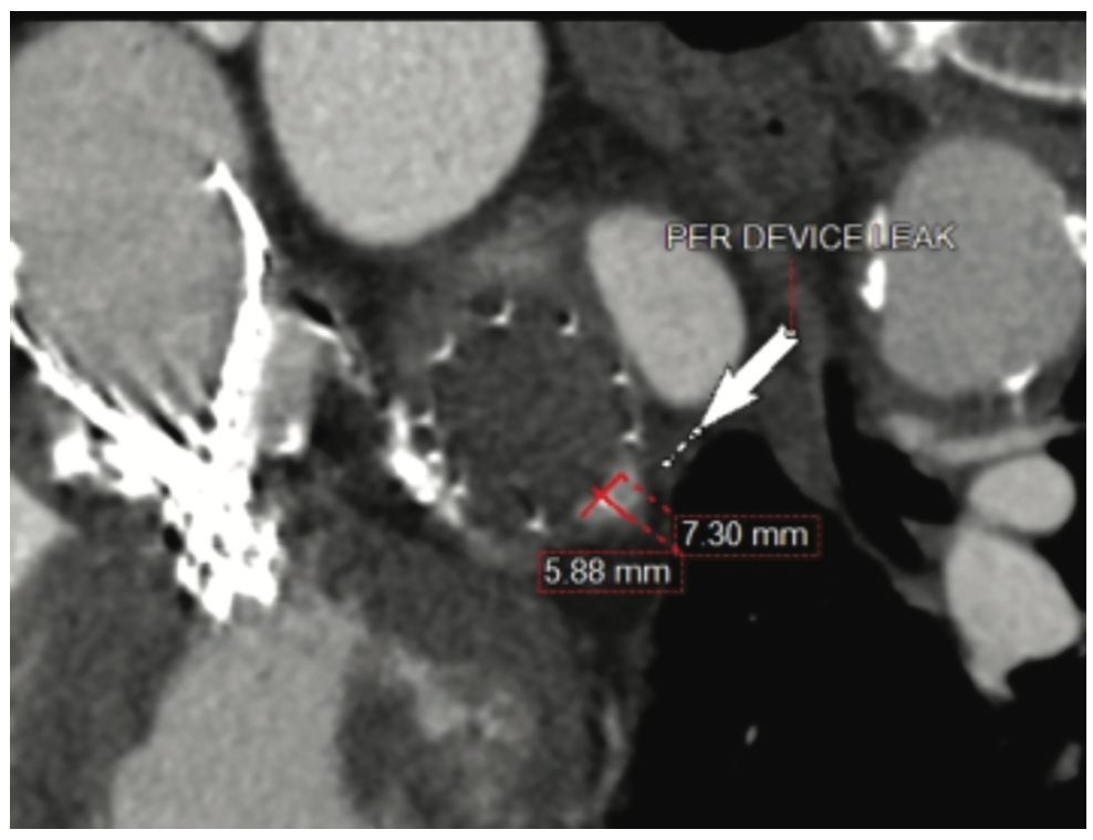 Speiser Atrial Appendage Leak Figure 3