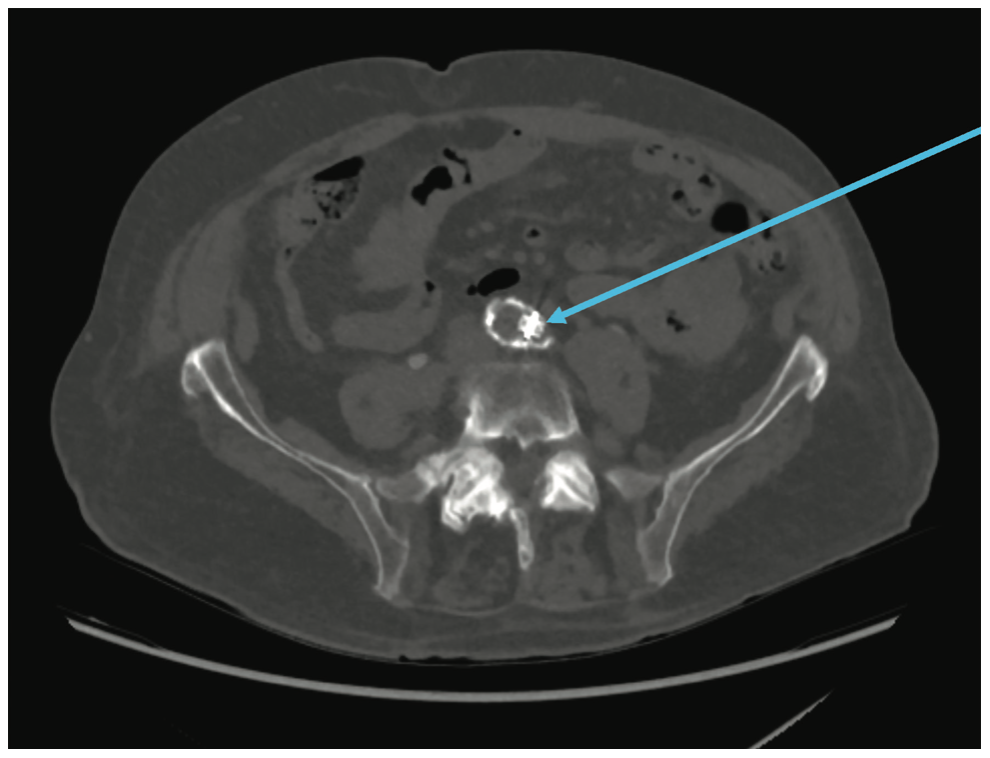Speiser Atrial Appendage Leak Figure 4