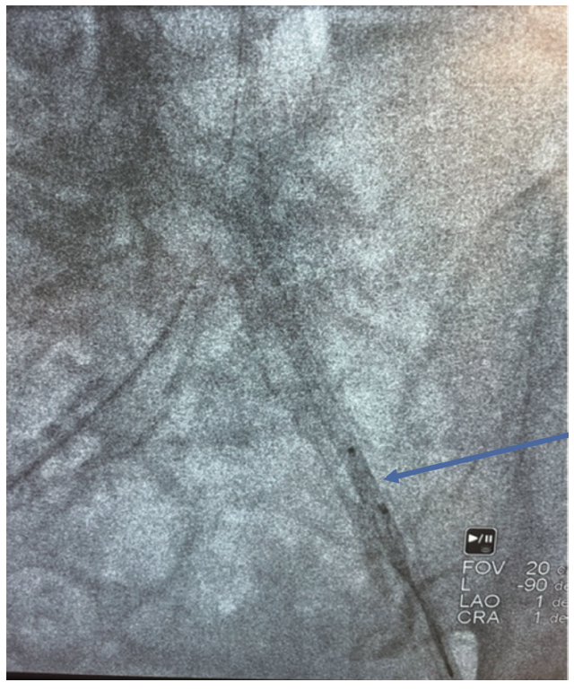 Speiser Atrial Appendage Leak Figure 5