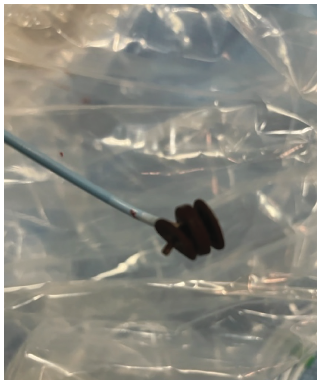 Speiser Atrial Appendage Leak Figure 6