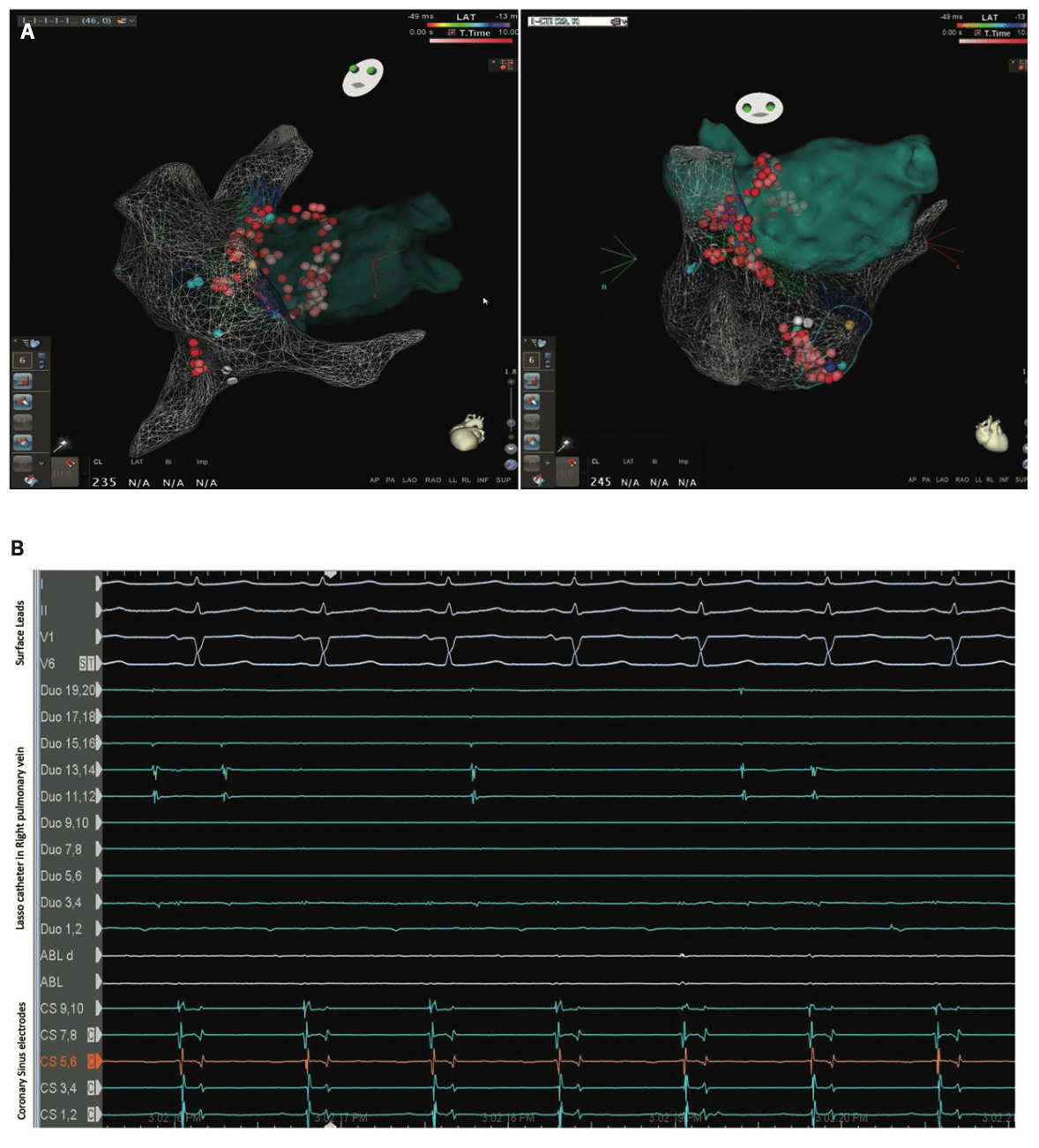 Sridhar Tachycardia Figure 3