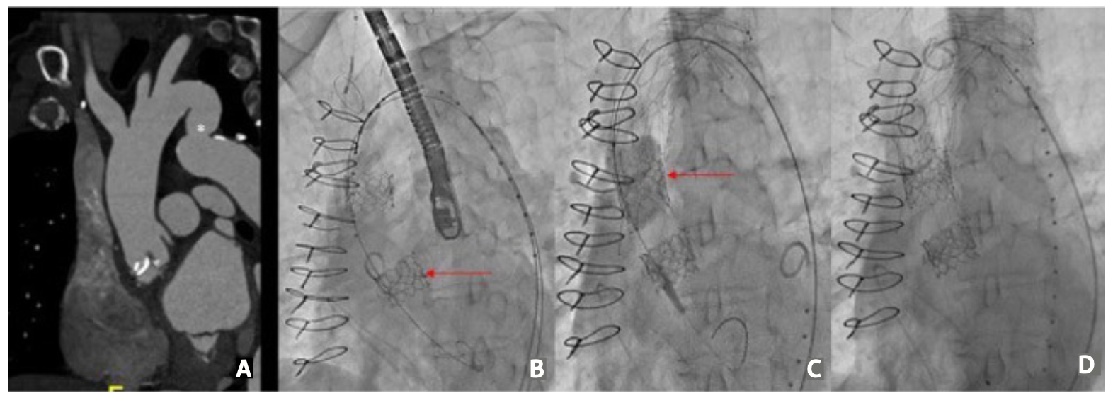 Stathogiannis TAVR Figure 1
