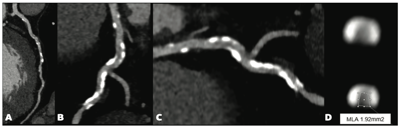 Sturm Anderson Calcified PCI Figure 1