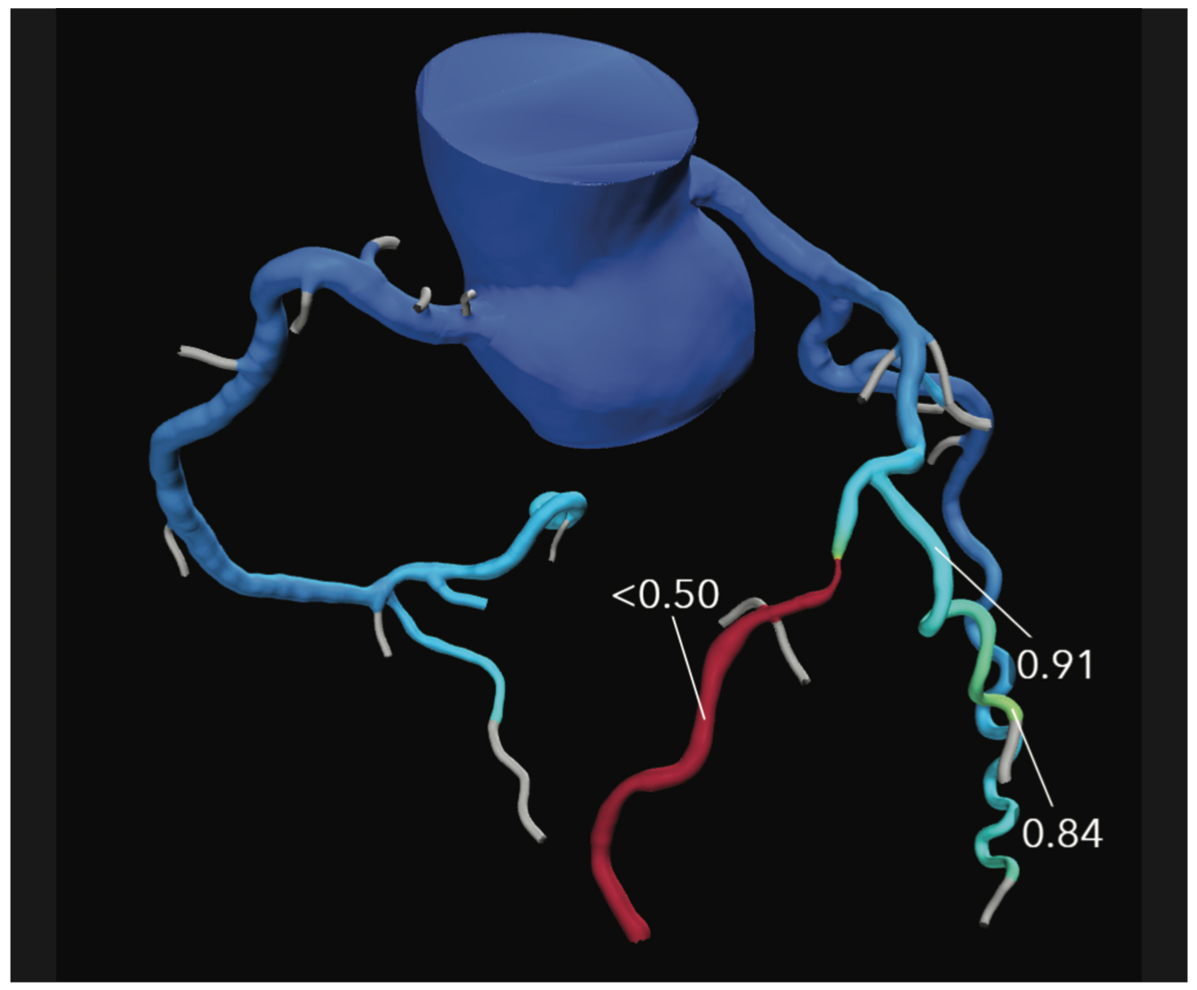 Sturm Anderson Calcified PCI Figure 2