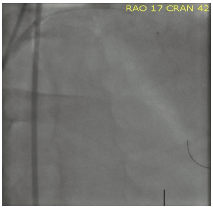 Sturm Anderson Calcified PCI Figure 4