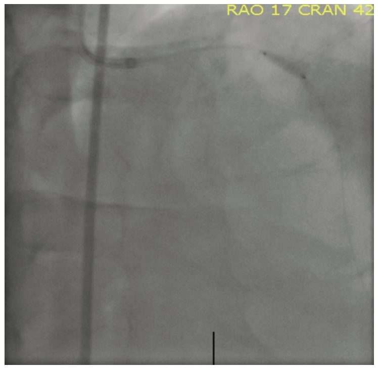 Sturm Anderson Calcified PCI Figure 5