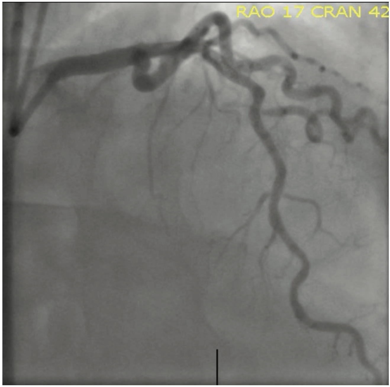 Sturm Anderson Calcified PCI Figure 7