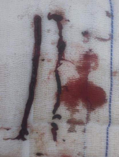 Figure 4. Thrombectomy was performed on the right femoral, tibialis anterior, and tibialis posterior arteries.