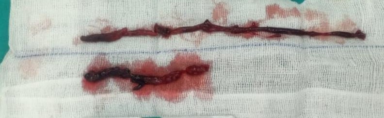 Figure 6. Femoral artery thrombectomy was performed.