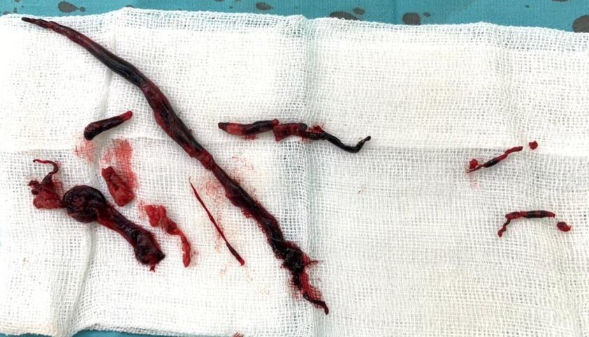 Figure 8. The patient underwent thrombectomy on the radial artery, ulnar artery, and brachialis artery.