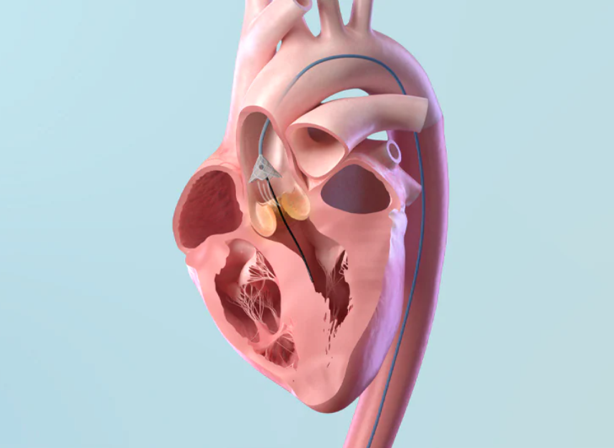 TAVR illustration