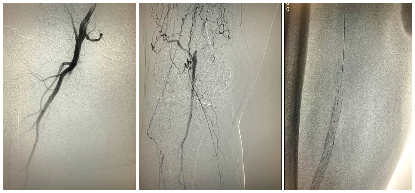 Tai “Tip In” Technique Figure 1