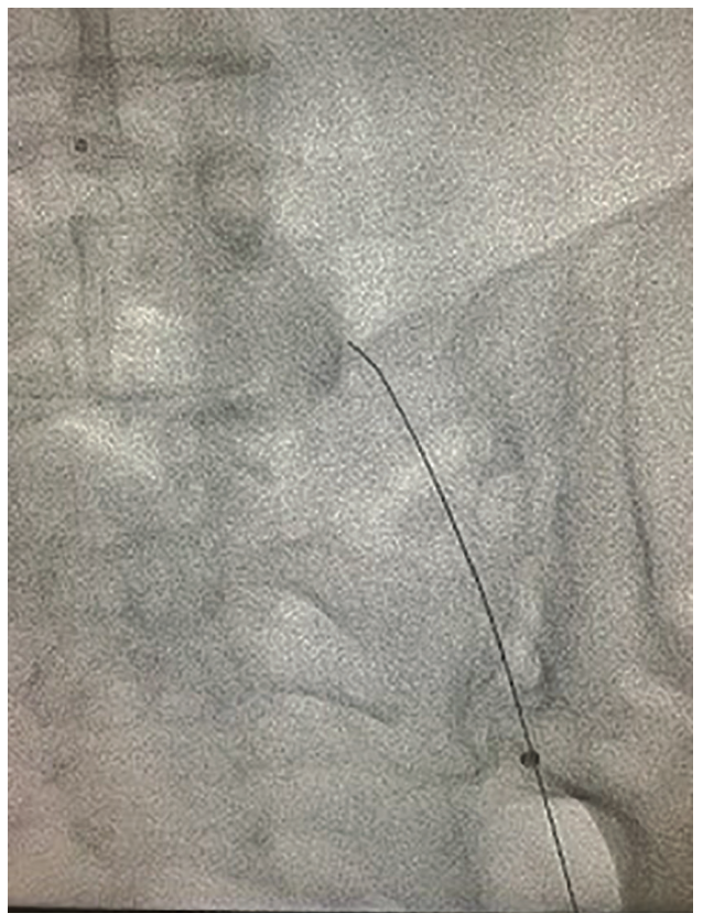 Tai “Tip In” Technique Figure 2