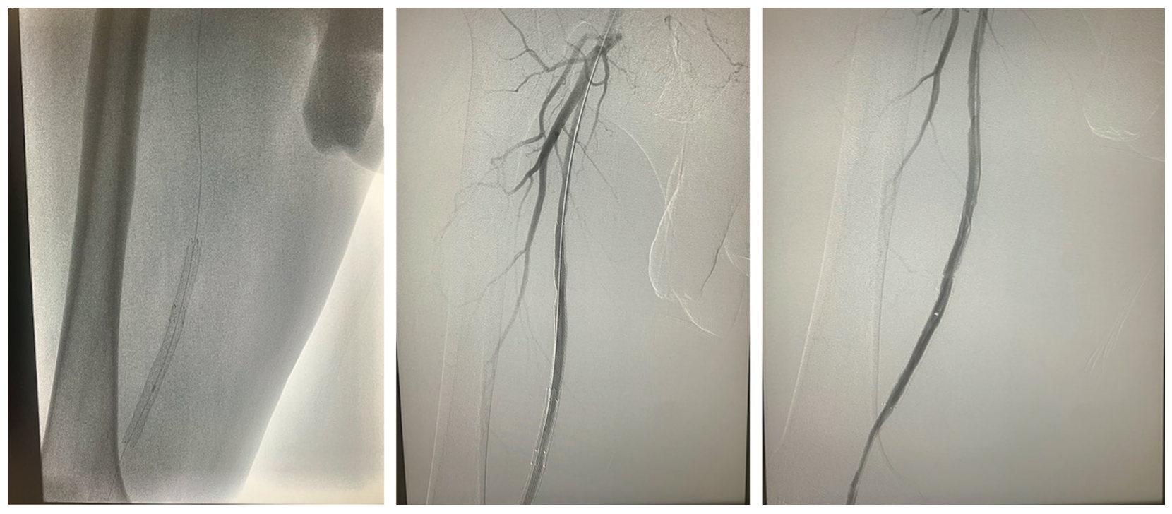 Tai “Tip In” Technique Figure 3