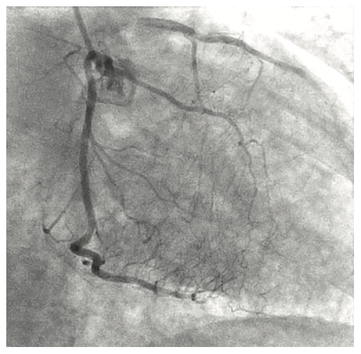 Tai PercAx Impella Figure 1