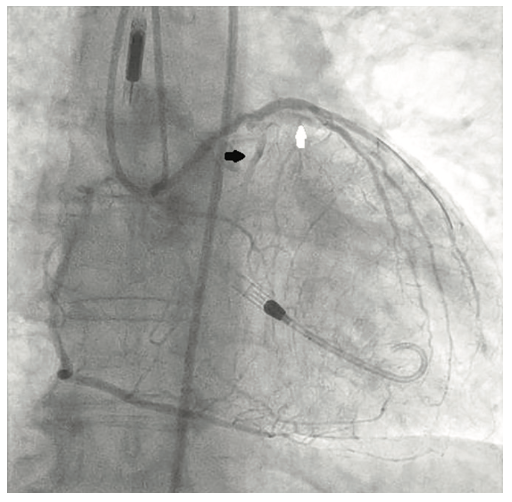 Tai PercAx Impella Figure 10
