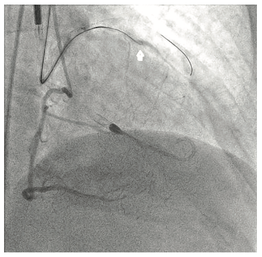 Tai PercAx Impella Figure 11