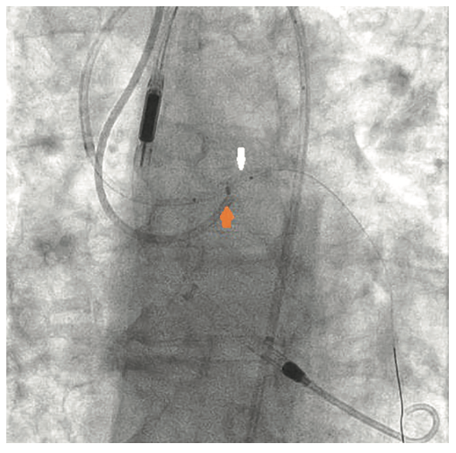 Tai PercAx Impella Figure 13