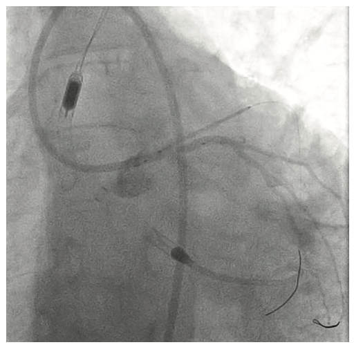Tai PercAx Impella Figure 14