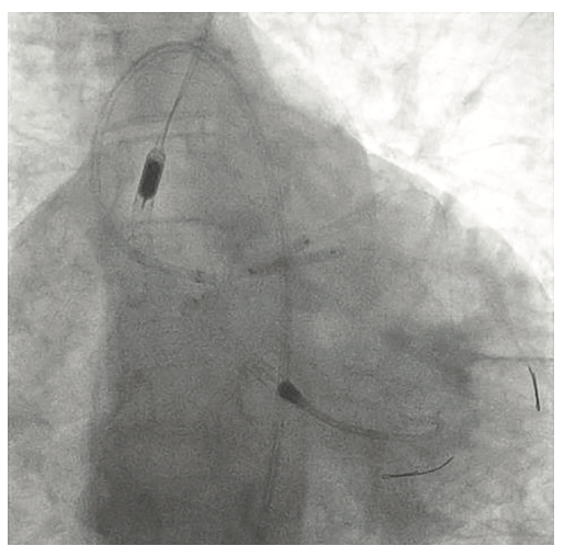 Tai PercAx Impella Figure 15