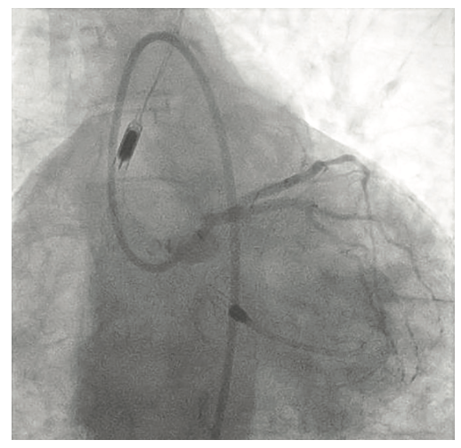 Tai PercAx Impella Figure 16