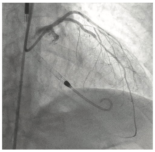 Tai PercAx Impella Figure 17