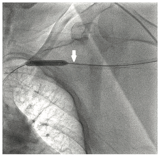 Tai PercAx Impella Figure 18