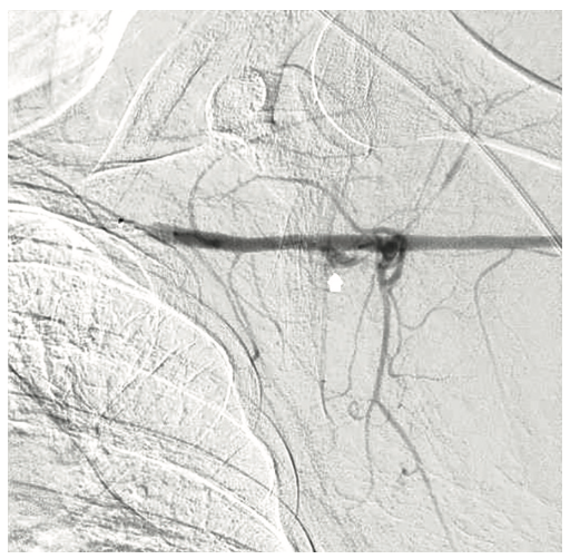 Tai PercAx Impella Figure 19