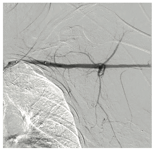 Tai PercAx Impella Figure 20