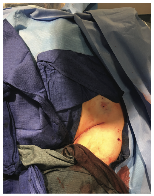 Tai PercAx Impella Figure 21