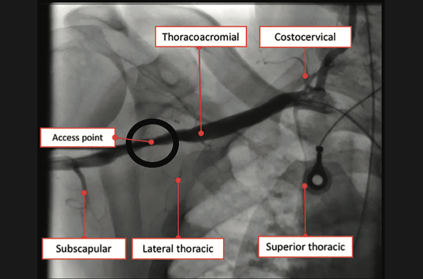 Tai PercAx Impella Figure 23