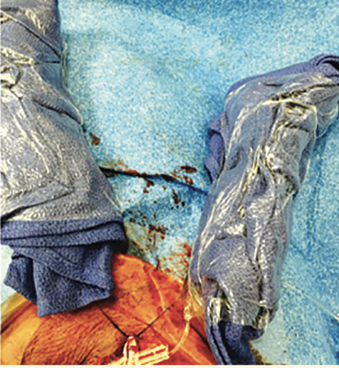 Tai PercAx Impella Figure 24