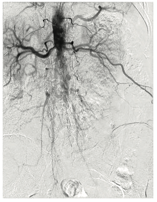 Tai PercAx Impella Figure 3