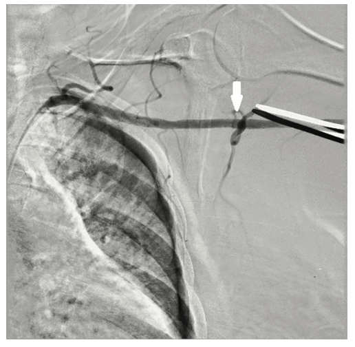 Tai PercAx Impella Figure 4