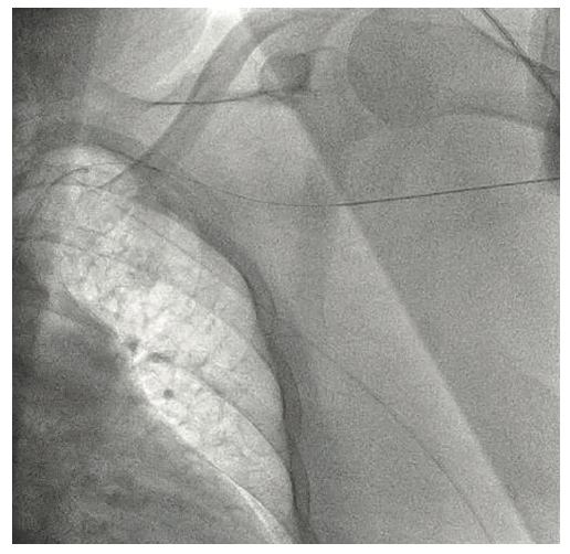 Tai PercAx Impella Figure 5