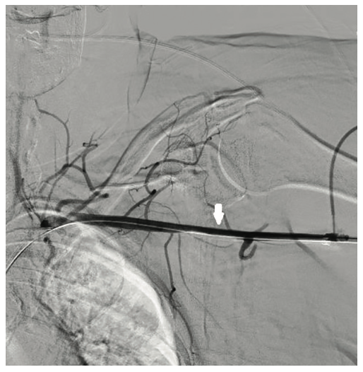 Tai PercAx Impella Figure 6