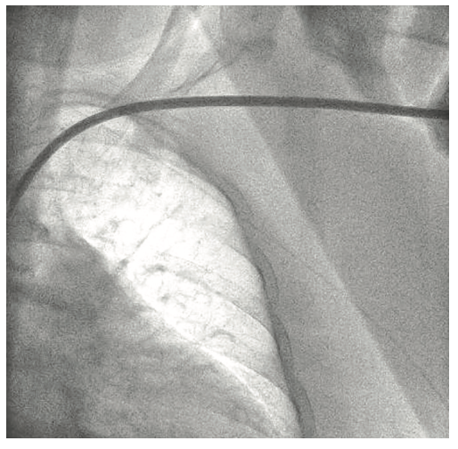 Tai PercAx Impella Figure 7